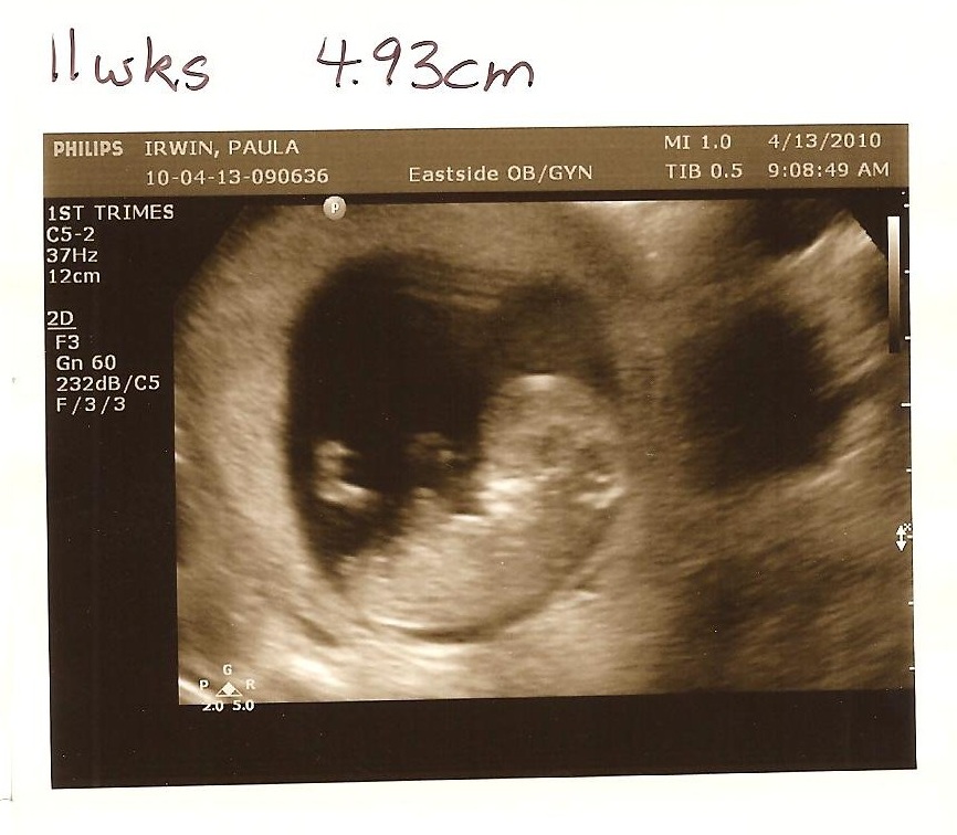 Irwin with an "I": 11 Week Ultrasound