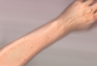 Moles vs Freckles – How to Tell the Difference and ...