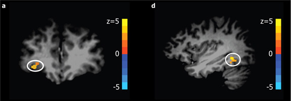 [orbitofrontal-fusiform.jpg]
