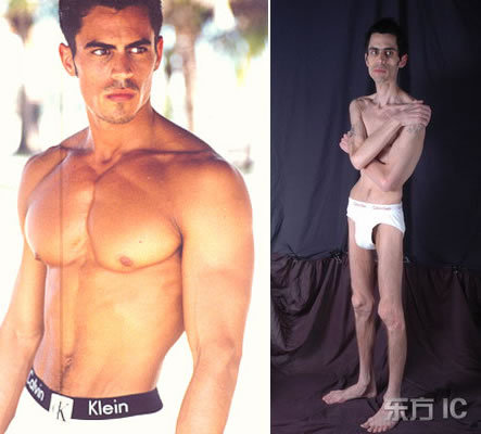 anorexia_tambem_afeta_o_universo_masculino.jpg