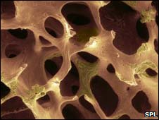 [_45493125_osteoporosis.jpg]