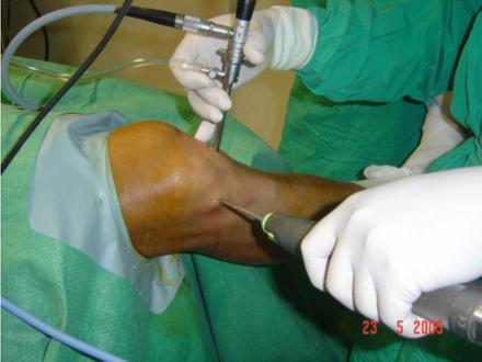 Examen de artroscopia de rodilla