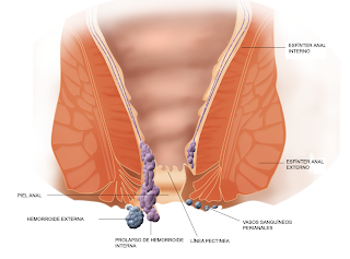 Tratamiento de hemorroides con laser sin dolor en Guadalajara Mexico Tratamiento de hemorroides con laser sin dolor en Guadalajara Mexico