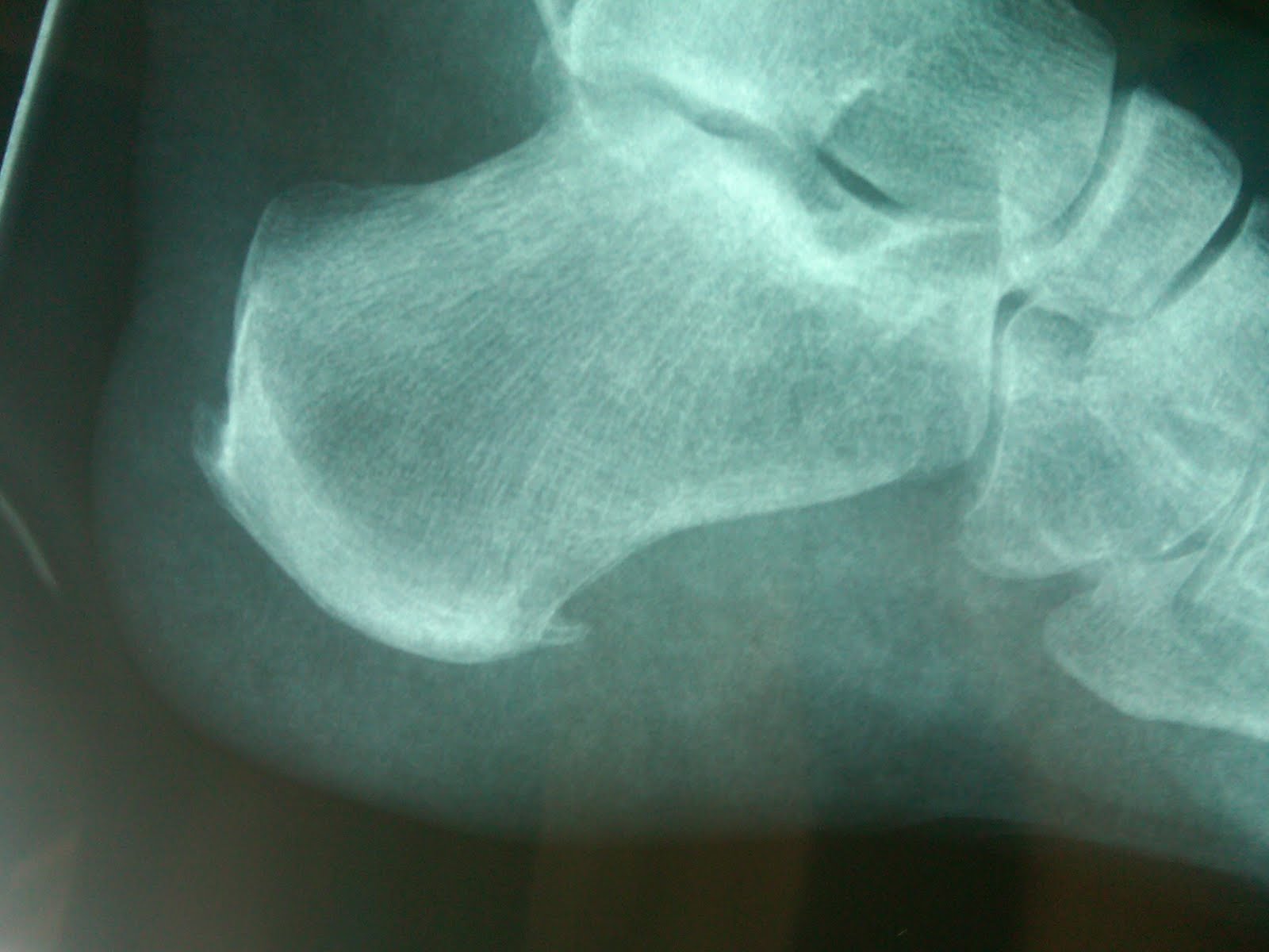 Triathlon Training blog of Mary Stella Stabinsky heel spurs