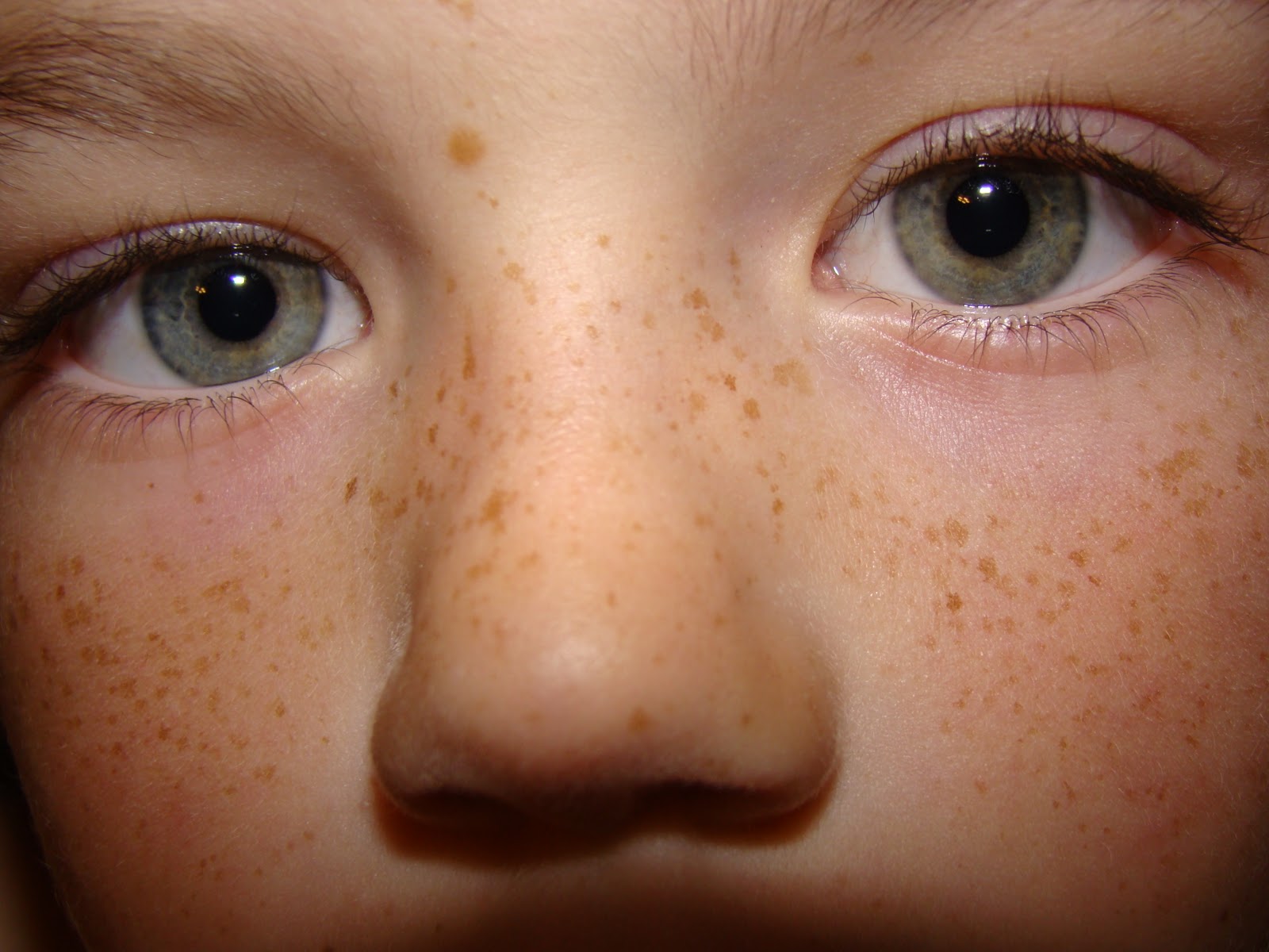 Freckle - Wikipedia