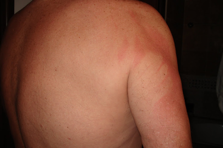 Missed sunscreen