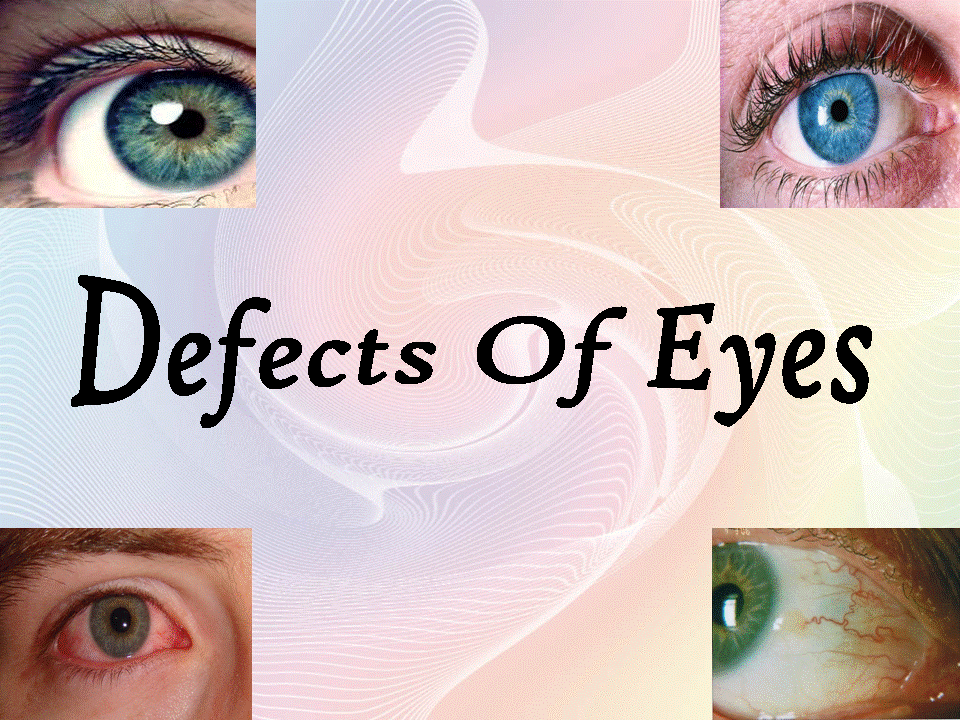 Defect Of Eyes.