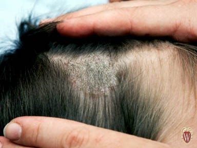 what causes fungal infection on scalp what causes fungal infection on scalp