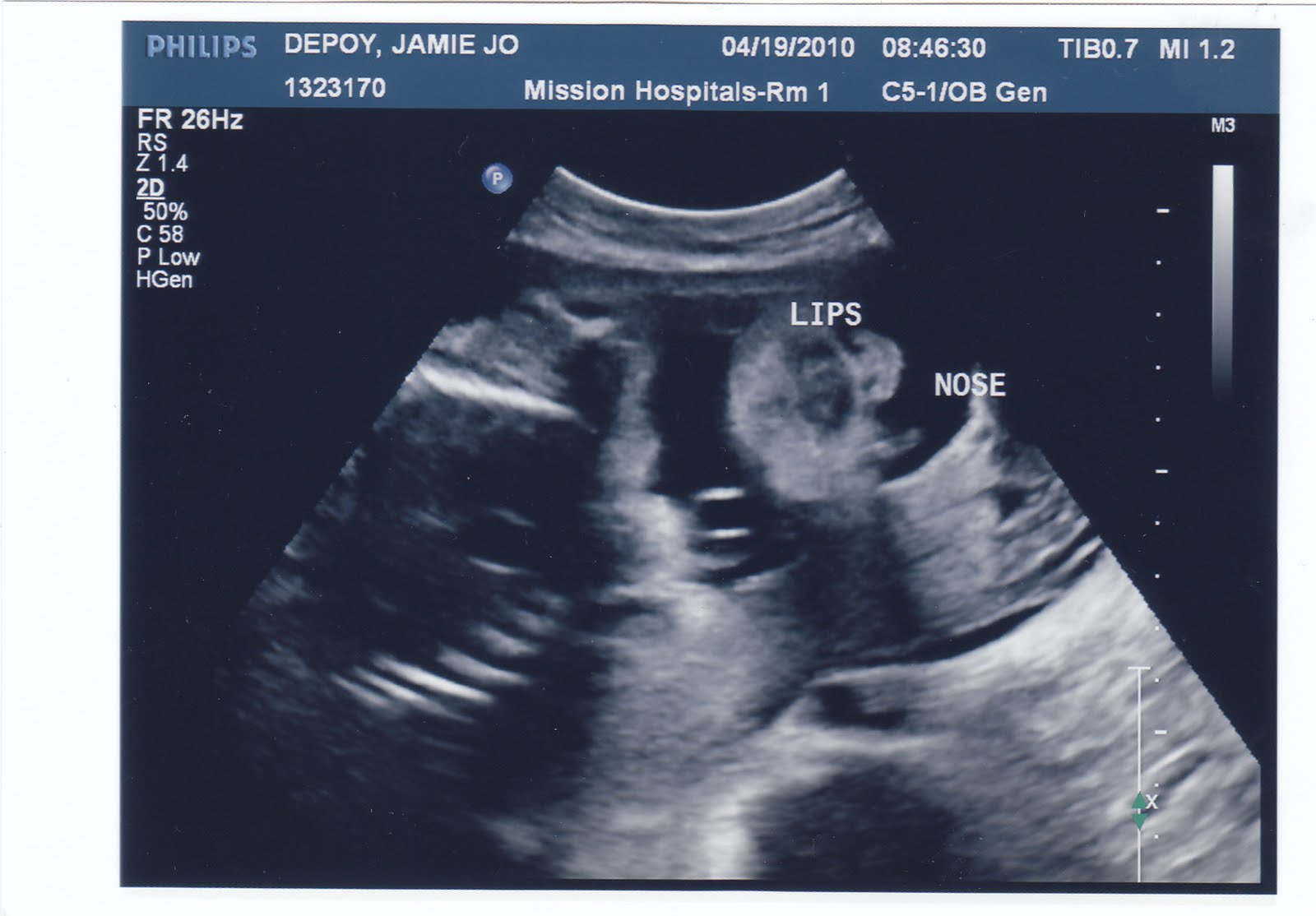 Sticks and Stones Ultrasound Pics