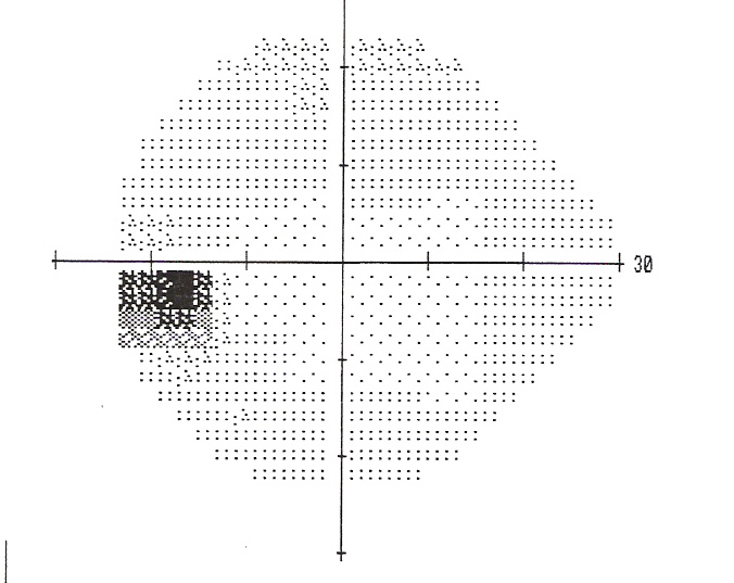 The secret of the blind spot in our vision Elixir Of Knowledge