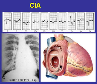 Comunicación interauricular e hipertensión pulmonar