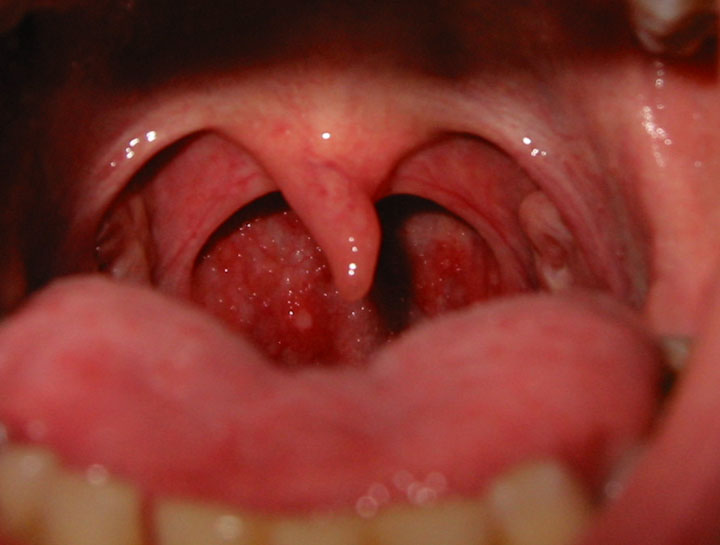 Throat Photo 2