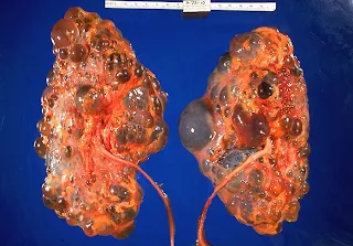 Kidney Disease