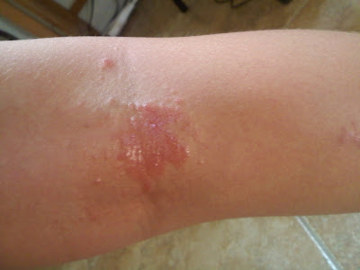 Mold Rash Pictures 110