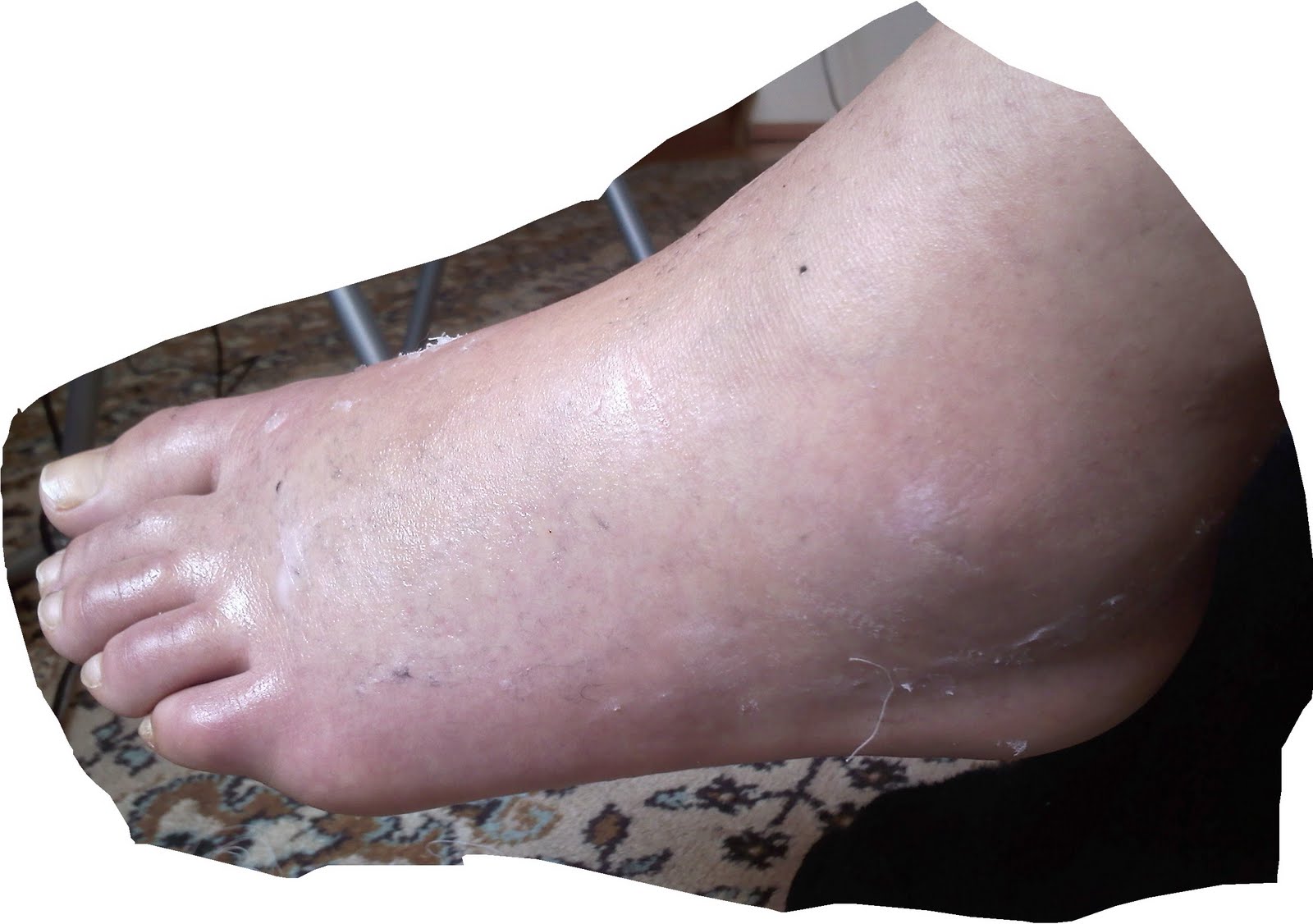 Piciorul umflat de la varicoză și doare