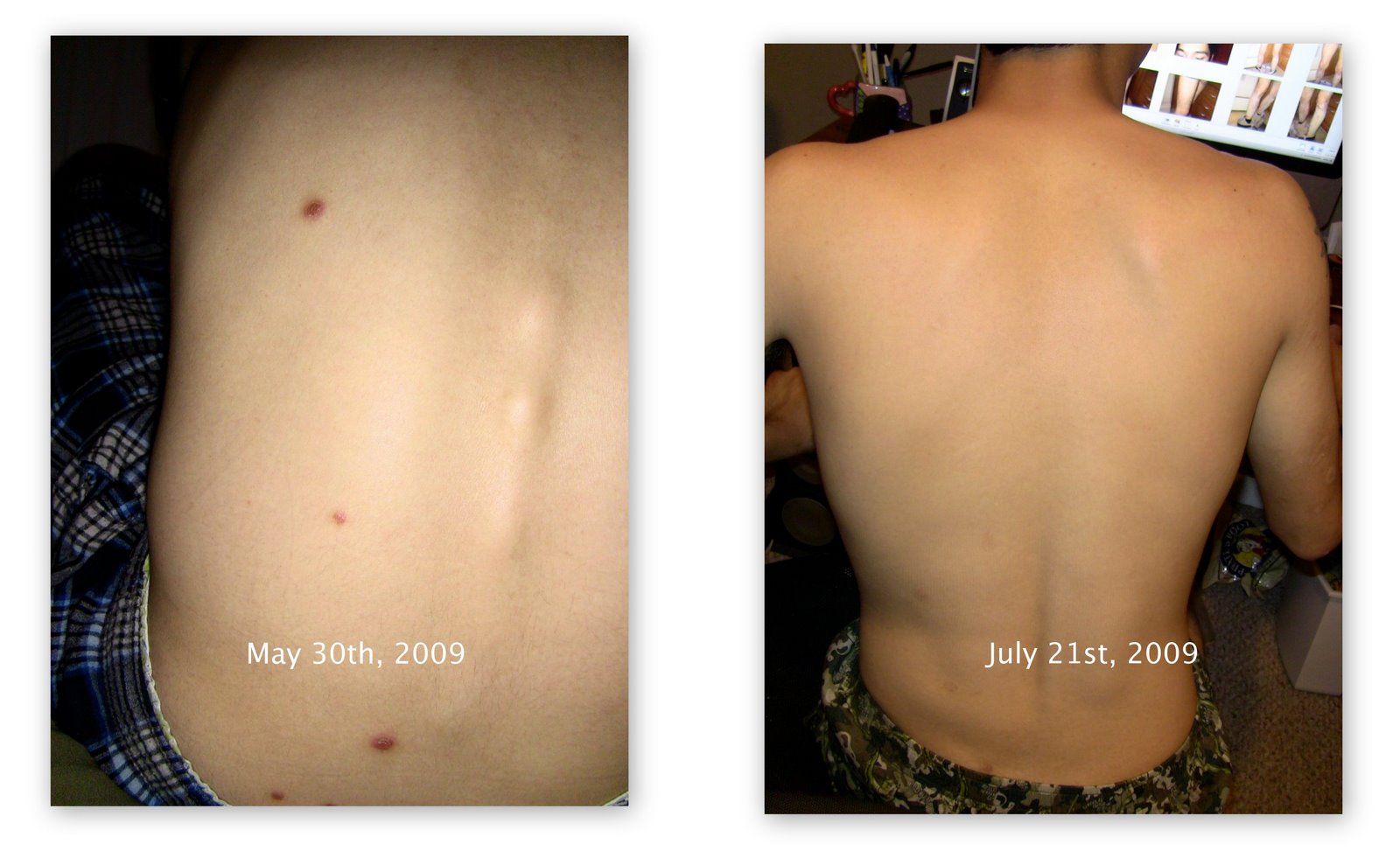 [Psoriasis+Media2.jpg]