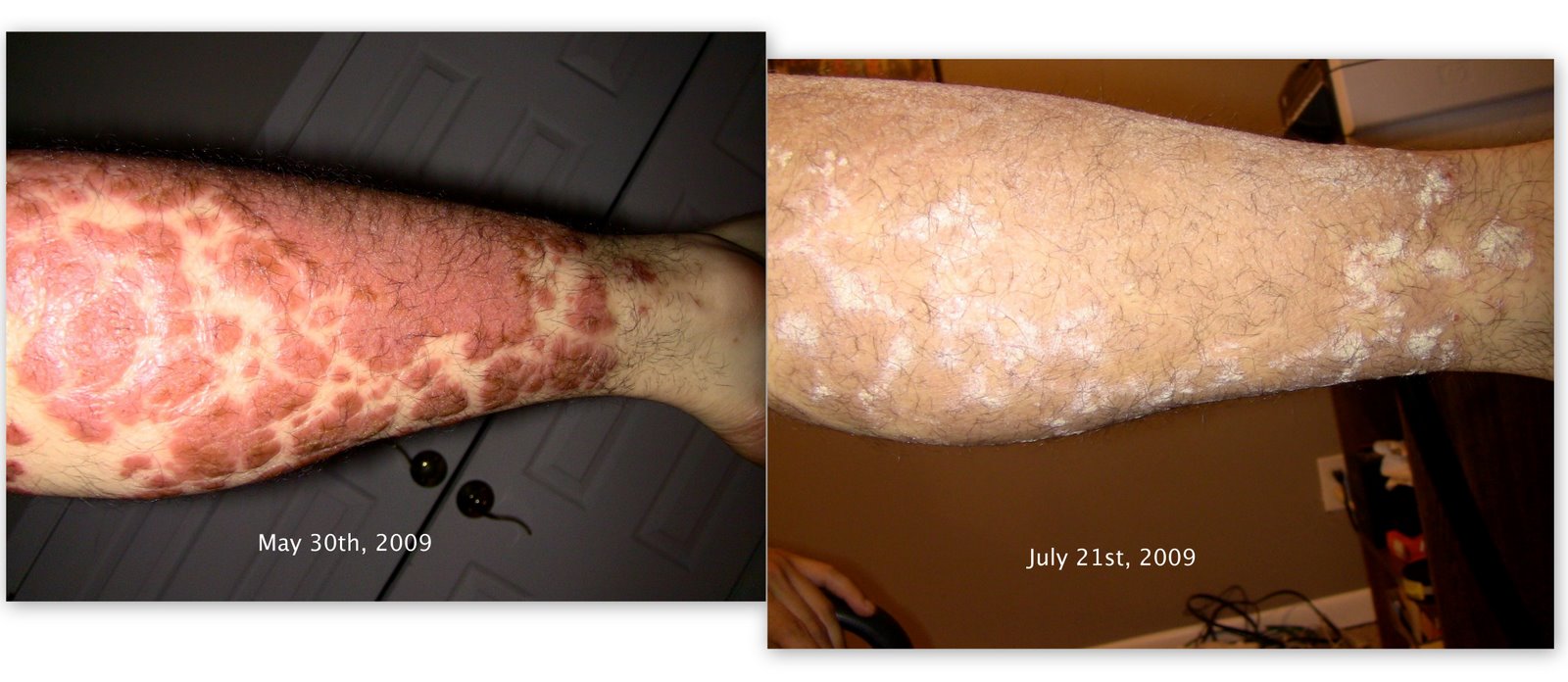 [Psoriasis+Media8.jpg]