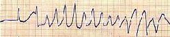 [sindrome_qt_electrocardiograma22.jpg]