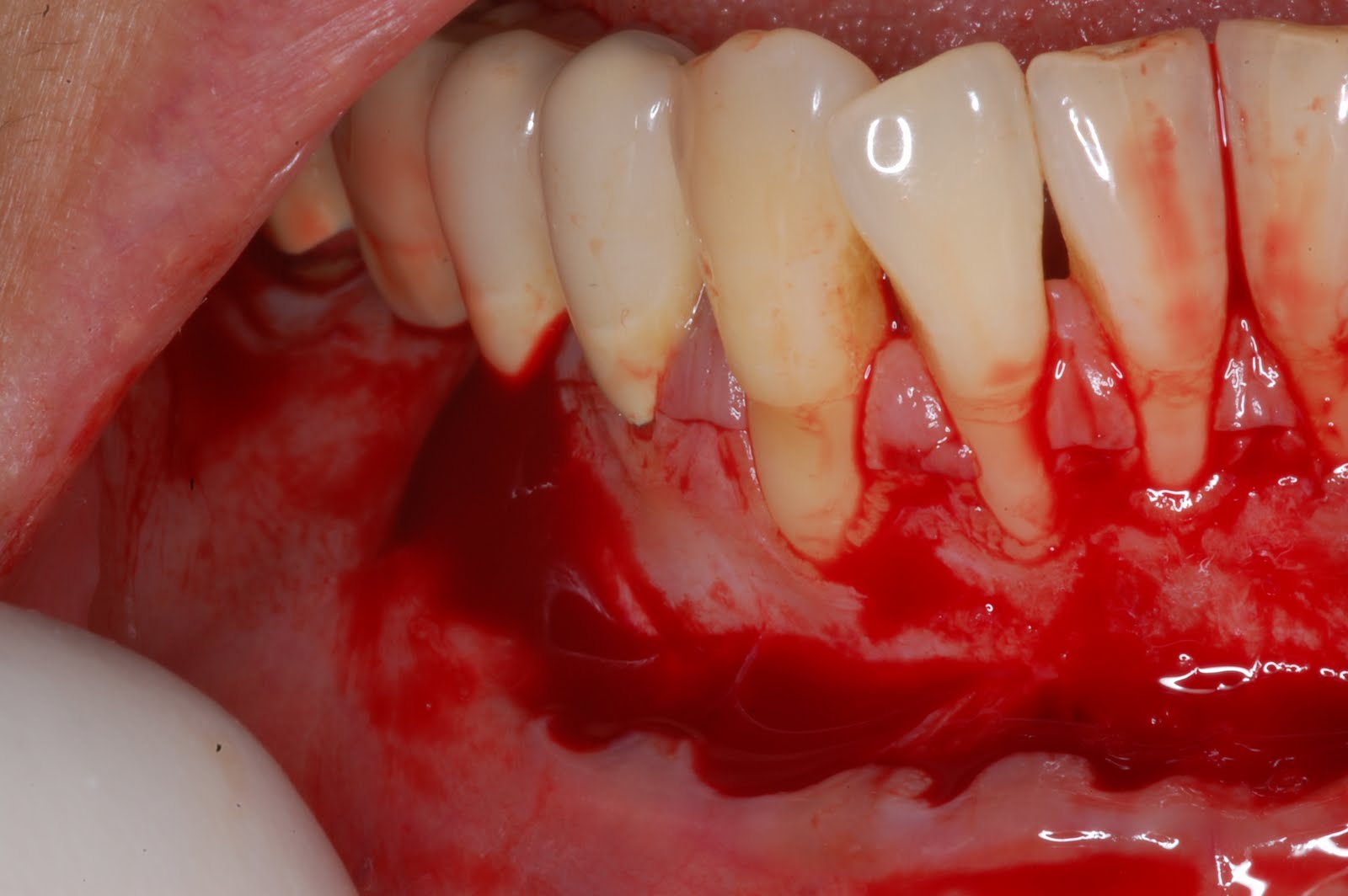 Periodontal Implant Cases by Dr. Thomas Kang Free Gingival Grafts