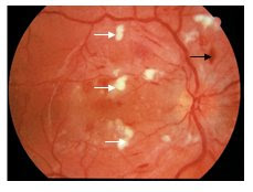 hipertenzije, retinopatije