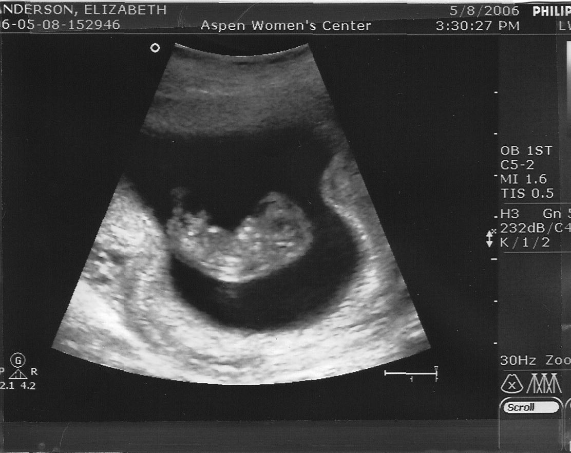 10+week+ultrasound (image)