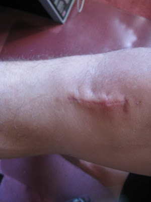 ACL SURGERY RECOVERY: Recovering from ACL surgery: Week 4 - ACL Surgery