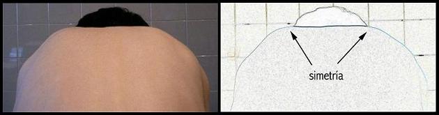 SIGNO DE ADAMS NEGATIVO