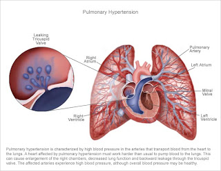 hypertension pulmonary health healthy let