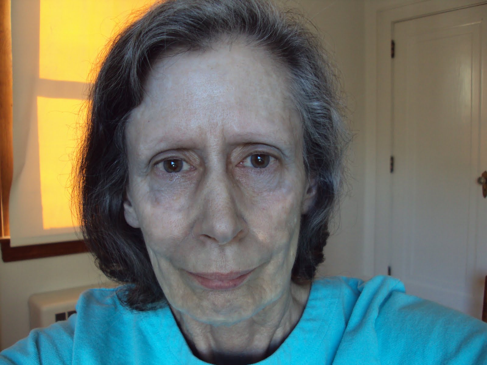 Argyria Woman With Gray Skin