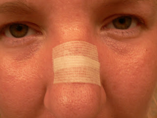 mohs surgery on nose