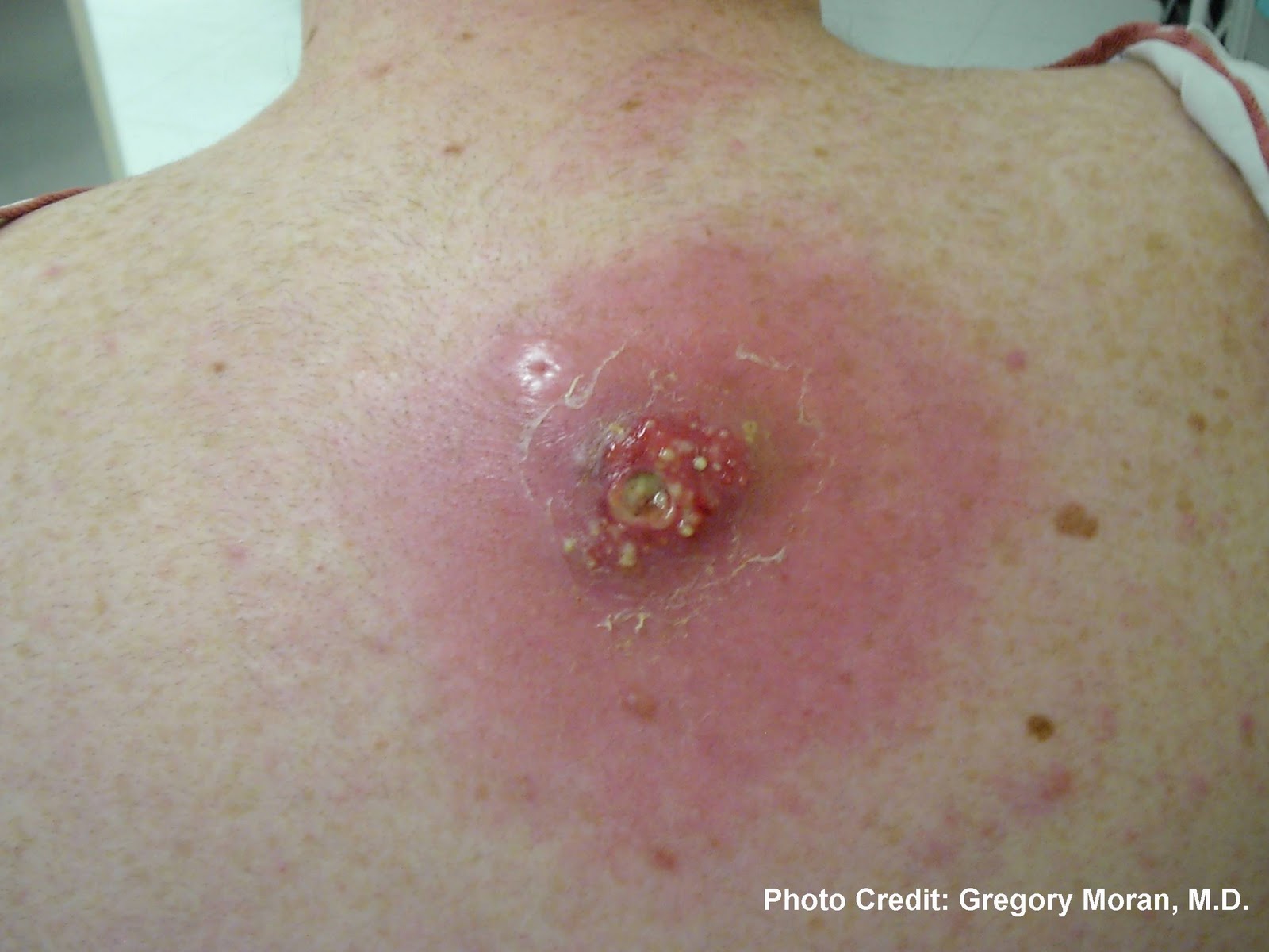Slideshow: Boils and the Skin - WebMD