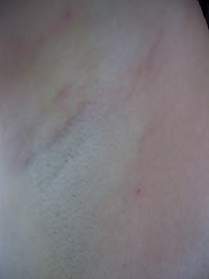 axillary hyperhidrosis