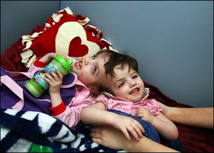 Fun Venture Conjoined Twins Krista and Tatiana (10 photos)