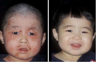 Healthy and Fit: Health Care Tips - Eczema Skin Disease ...