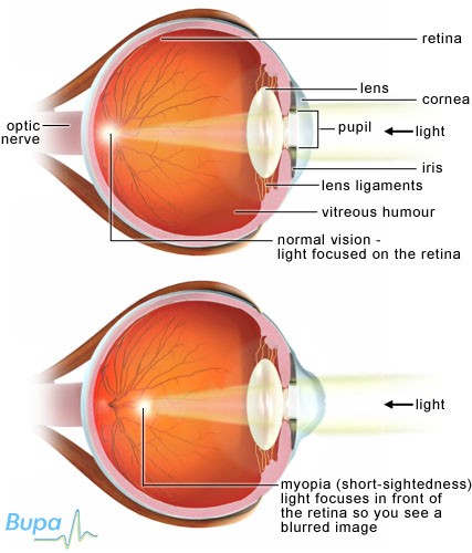 myopia 1 5 hogyan kell kezelni a tiszta látásgyakorláshoz