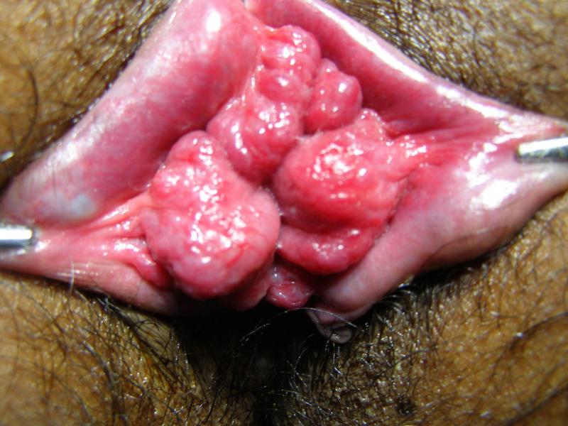 Health risks with anal sex Join. Health risks with anal sex
