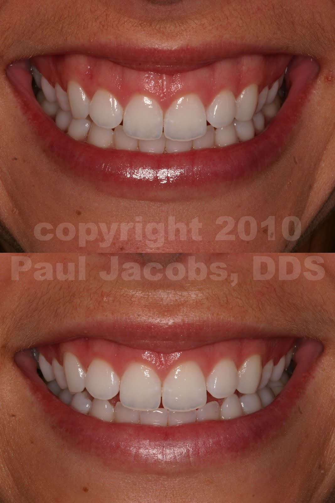 Dental Nation Gummy Smile Solution with Lip Repositioning Surgery