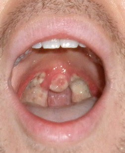 Tonsils In Adult 46