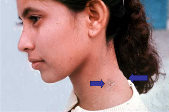 Picture of Epidermal Inclusion Cyst (EIC) on MedicineNet