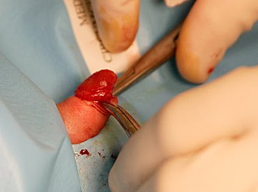 circumcision-08-big.jpg