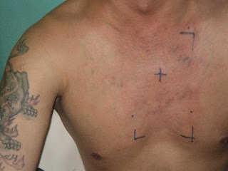 PACES MRCP UK - Where MRCPians Meet Since 2006: SVC Obstruction