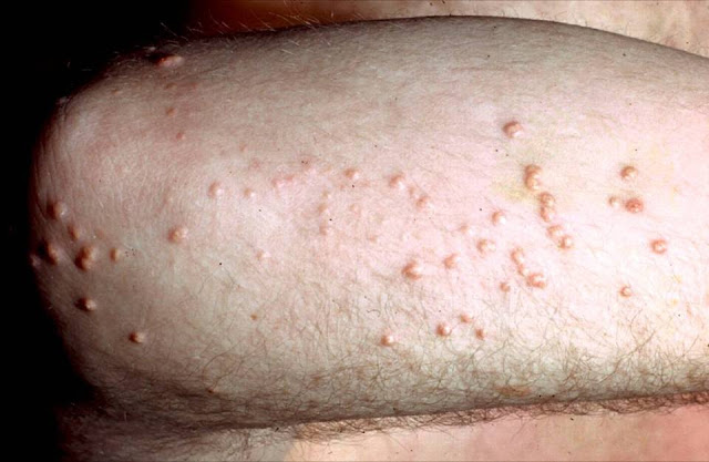 Xantom Caminhos & Reencontros...: Xantoma de triglicérides