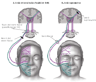 Medicina APS: Parálisis de Bell