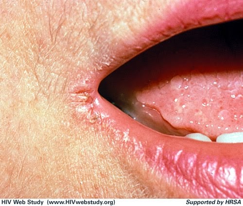 Dry Mouth Dry Throat After General Anaesthesia Difficulty Swallowing Food Dry Mouth Dry Throat After General Anaesthesia Difficulty Swallowing Food