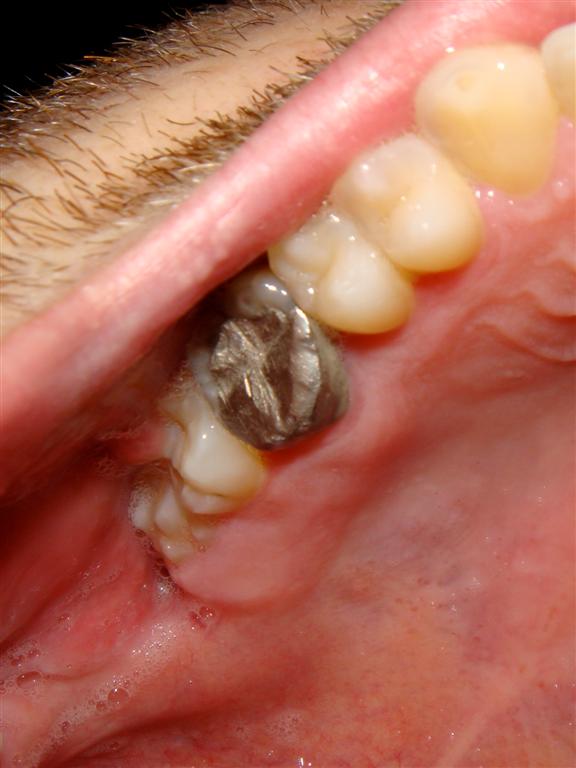 [DALE+UPPER+1ST+MOLAR+(Large).JPG]