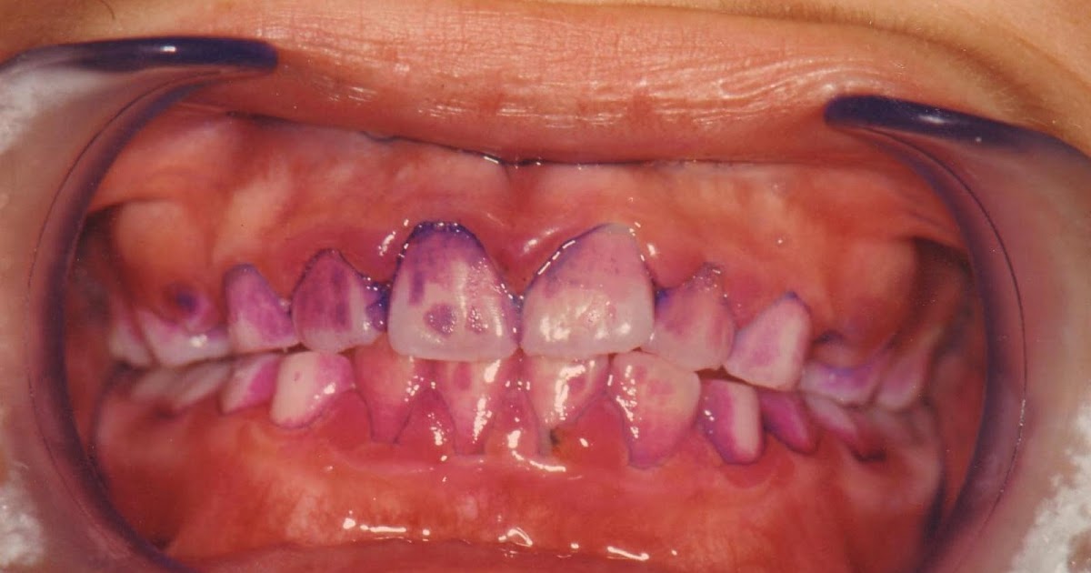 Revelado de placa dental en casa Odontologia Salud y Hoy!