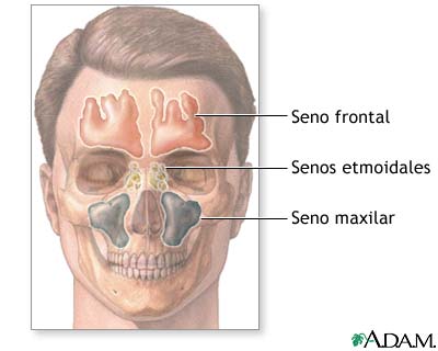 Dolor de cabeza sinusal perforación del oído Dolor de cabeza sinusal perforación del oído