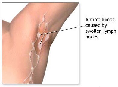 Underarm (Armpit) Rash - Pictures, Symptoms, Causes and ...
