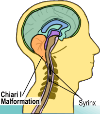 Anatomy of a chiari malformation