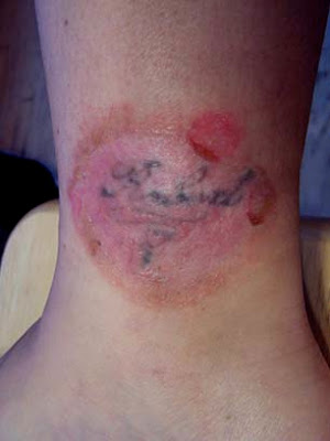 Dermabrasion tattoo removal is the most effective method of tattoo removal.
